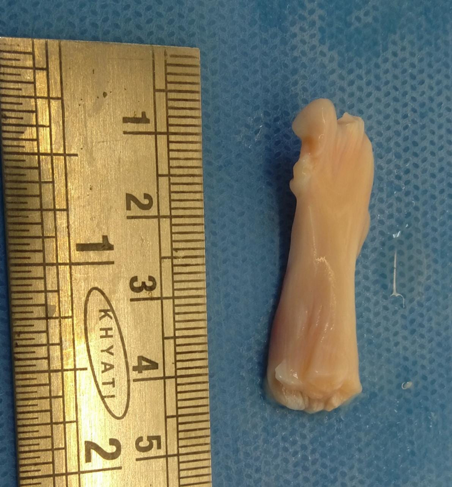 Popliteus Tendon - PT001